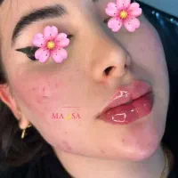 تزریق ژل و بوتاکس تضمینی|خدمات آرایشگری و زیبایی|قرچک, مهدیه|دیوار