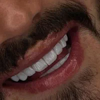 دندان پزشکی /کامپوزیت زیبایی /لمینت