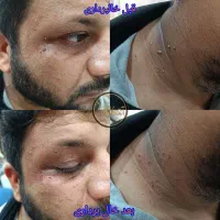 رفع جای جوش ،ریزش مو ،خال برداری برای آقایان|خدمات آرایشگری و زیبایی|خرمشهر, |دیوار