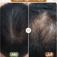 درمان طاسی مو