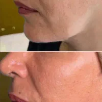 بوتاکس، ژل و نخ ۸۰ درصد قیمت