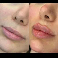آموزش تحصصی ژل و بوتاکس و آنزیم|خدمات آموزشی|اسلام‌شهر, شهرک واوان|دیوار