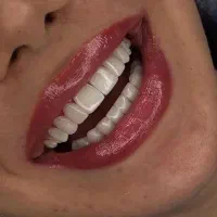 دندانپزشکی /کامپوزیت دندان /ایمپلنت و لمینت|خدمات آرایشگری و زیبایی|قم, سیدان|دیوار