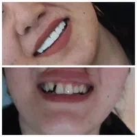 کامپوزیت زیبایی دندان درکلینیک دندانپزشکی