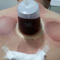 حجامت فصد زالو درمانی بادکش گرم و سرد در محل شما|خدمات آرایشگری و زیبایی|اسلام‌شهر, مسکن مهر اسلاشهر (شهرک امام خمینی)|دیوار