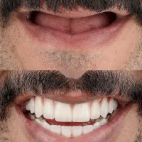 ایمپلنت فقط با پیش پرداخت 5990|خدمات آرایشگری و زیبایی|تهران, هروی|دیوار