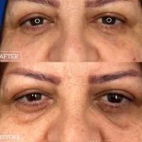 تزریق ژل لب و بوتاکس|خدمات زیبایی و سلامت|تهران, شکوفه (عبدل آباد)|دیوار
