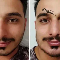 تزریق چربی ، فیلر بادی، ژل، بوتاکس در مطب|خدمات آرایشگری و زیبایی|شیراز, گویم|دیوار