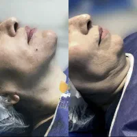 پکیج اقتصادی اندولیفت هایفوکندلا ۳۶بعدی دکترداریوش