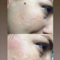 برداشت خال با خلال دندان|آرایشی، بهداشتی، درمانی|تربتحیدریه, پارک پرستار|دیوار