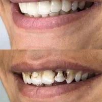 پر کردن دندان با تخفیف ویژه