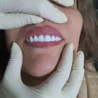 دندانسازی/دندان مصنوعی/ژله ای باشرایط استثنایی|خدمات زیبایی و سلامت|کرج, گوهردشت|دیوار