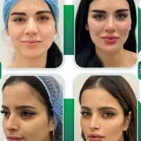 تزریق ژل،بوتاکس،سابسیژن،پی آرپی،مطب درمانی وزیبایی