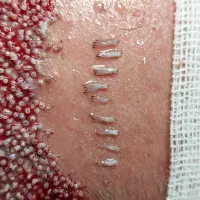 کاشت مو پر تراکم فقط ۱۰ ملیون