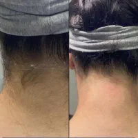 اف ویژه لاین لیزرموهای زائد،فول بادی فقط(۳۹۹)