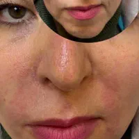 فیلر لب زیر چشم فیلر بادی نخ لیفت پی ار پی مزو|خدمات آرایشگری و زیبایی|اصفهان, سیچان|دیوار