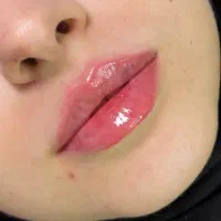 تزریق ژل و بوتاکس با مواد اورجینال