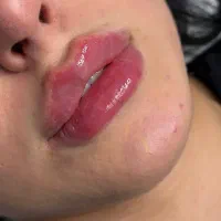 تزریق فیلر