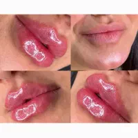 تزریق چربی .فیلر.نخ.ژل|خدمات آرایشگری و زیبایی|جهرم, |دیوار