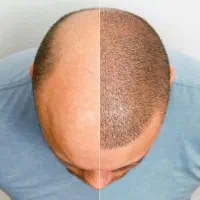 کاشت مو و ابرو در معتبر ترین کلینیک تهران|خدمات آرایشگری و زیبایی|تهران, فاطمی|دیوار