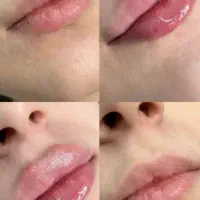 فیلر لب، زاویه سازی و جوانسازی با فرم طبیعی
