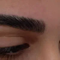 فیبروز و میکروبلیدنگ