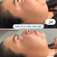 لاغری و لیفت تضمینی