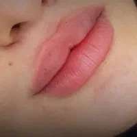 ژل،بوتاکس(خدمات توسط پزشک)