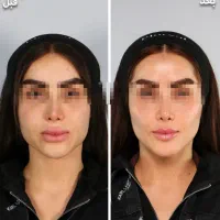 تزریق ژل لیفت با نخ و فیلر بادی