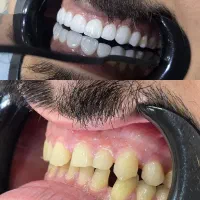 جشنواره دندانپزشکی اقساطی بدون پیش پرداخت|خدمات آرایشگری و زیبایی|شیراز, ستارخان|دیوار