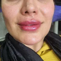 آف ویژه فیلر ، بوتاکس ، مزو ، نخ ، پی آر پی|خدمات آرایشگری و زیبایی|شیراز, قصرالدشت|دیوار