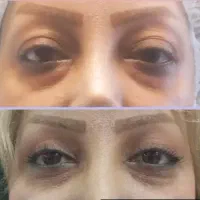 پزشک مسلط به جراحی بلفاروپلاستی|خدمات آرایشگری و زیبایی|تهران, سلسبیل شمالی|دیوار