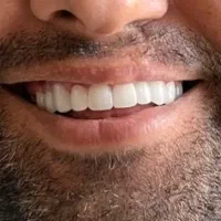 تخفیف ویژه ایمپلنت با شرایط اقساط توسط جراح