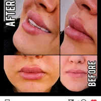 ژل،بوتاکس،آنزیم تراپی اقایون وخانوما