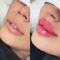 ژل بوتاکس صورت وضدتعرق دست زیربغل مزوتراپی پی ارپی
