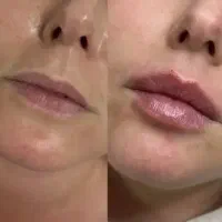 مدل فیلر بادی