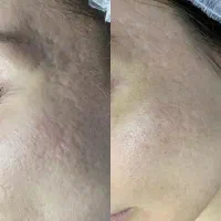 مزونیدلینگ ، PRP ، مزوتراپی صورت و مو|خدمات آرایشگری و زیبایی|دوگنبدان, |دیوار