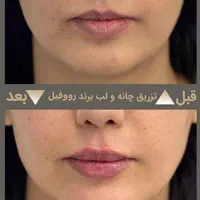 تزریق حرفه ای فیلر در کلینیک زیبایی و لیزر راویس|خدمات آرایشگری و زیبایی|کاشان, رجایی|دیوار