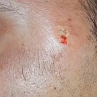 خال برداری و رفع کک ومک|خدمات آرایشگری و زیبایی|رشت, رودباری|دیوار