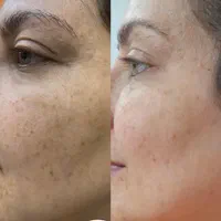 خدمات ریمو تتو،رفع کک و مک کلینک دکتر شریفی|خدمات آرایشگری و زیبایی|فولادشهر, B4|دیوار