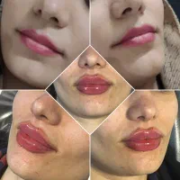 تزریق ژل و بوتاکس و مزوتراپی/ژل لب M تکنیک|خدمات آرایشگری و زیبایی|مشهد, نیروی هوایی|دیوار