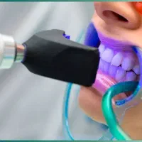 دندانپزشکی دندانسازی پونک سیمون بولیوار کامپوزیت|خدمات زیبایی و سلامت|تهران, شهرک کوهسار|دیوار