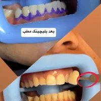 کامپوزیت دندان اقساطی بدون بهره|خدمات آرایشگری و زیبایی|اصفهان, عسگریه|دیوار