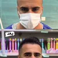 کاشت مو فول تراکم تضمینی|خدمات آرایشگری و زیبایی|گرگان, |دیوار