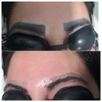 حذف انواع تتو صورت و بدن صددرصد تضمینی