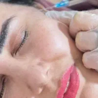 تزریق ژل وبوتاکس فیلر