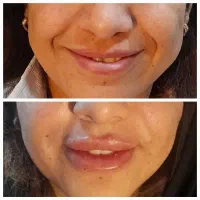 مدل ژل بوتاکس مزو ابرو مزوصورت میکرونیدلینگ فیشیال