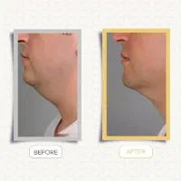 ساکشن غبغب|خدمات آرایشگری و زیبایی|رشت, گلسار|دیوار