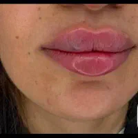 تخفیف ویژه ژل و بوتاکس