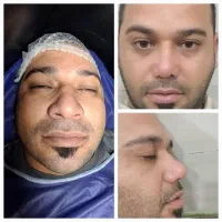 جراحی بینی بدون بیهوشی فقط ۲۰